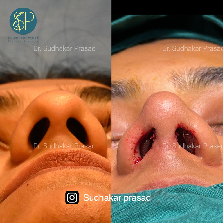 Rhinoplasty Before-After: Bottom View