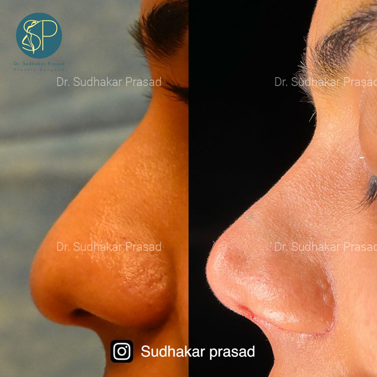 Rhinoplasty Before-After: Side View