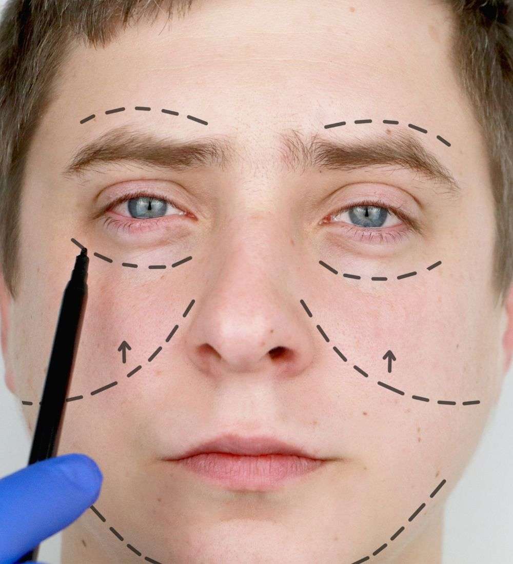 Facial Bone Correction